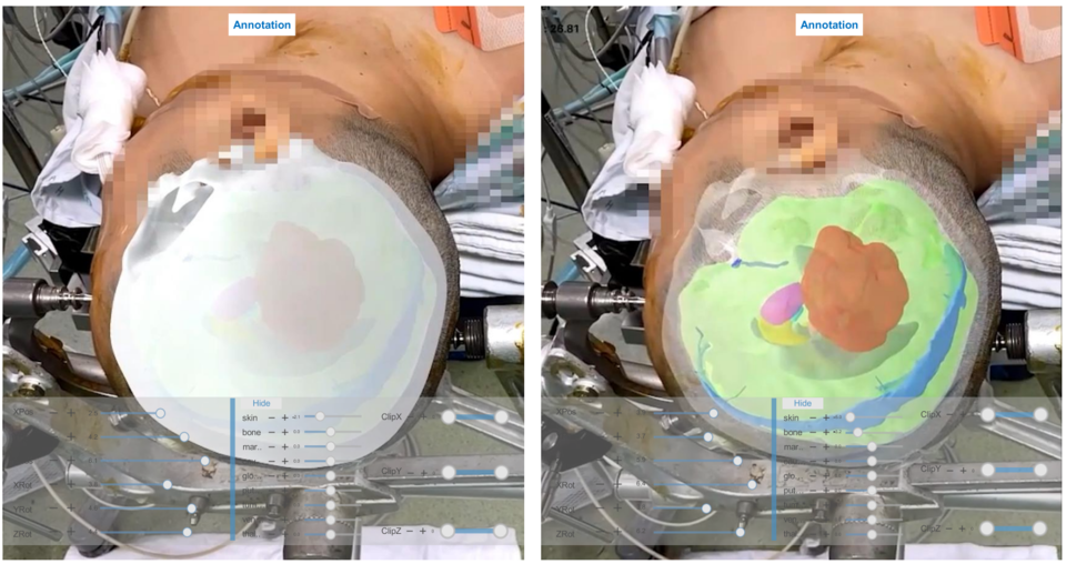 메디컬아이피의 실제 MEDIP PRO AR을 활용해 증강현실로 구현된 환자의 수술 부위