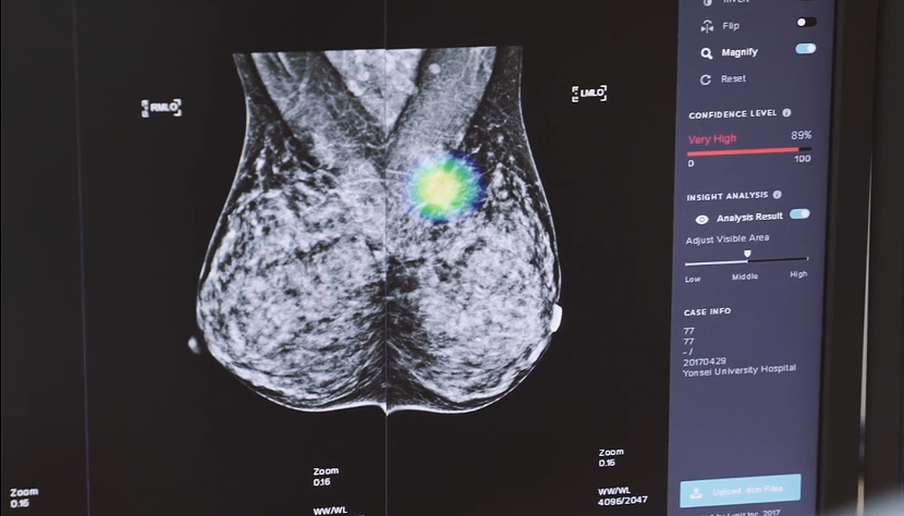 루닛 인사이트를 적용한 유암 검사시 유방촬영술은 유방밀도가 높은 데이터를 기반으로 학습해 판독결과를 높인다.