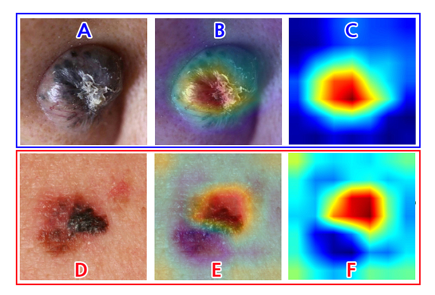 피부 종양 임상 및 인공지능 모델 인식 (상)기저세포암, (하)악성흑색종. 사진으로 a와 d는 임상 사진, b와 e는 임상 사진과 인공지능 모델 인식 결과 합성 사진, c와 f는 인공지능 모델 인식 사진이다. c와 f 사진에서 가운데 노란색 테두리 안의 빨간 부분이 악성 종양 진단 부분이다. c와 f를 통해 b와 e에서 실제 어느 부분이 악성 종양에 해당하는지 알 수 있다.