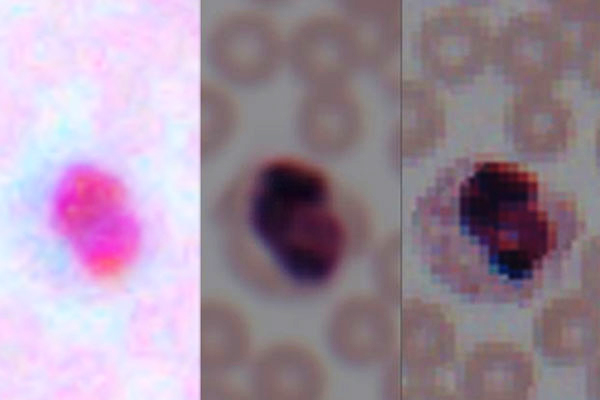 알고리즘에 의한 보정(중앙) 및 실험실 현미경 이미지(오른쪽), 촬영한 휴대폰 카메라(왼쪽)에서 혈액 촬영 이미지(사진:UCLA)