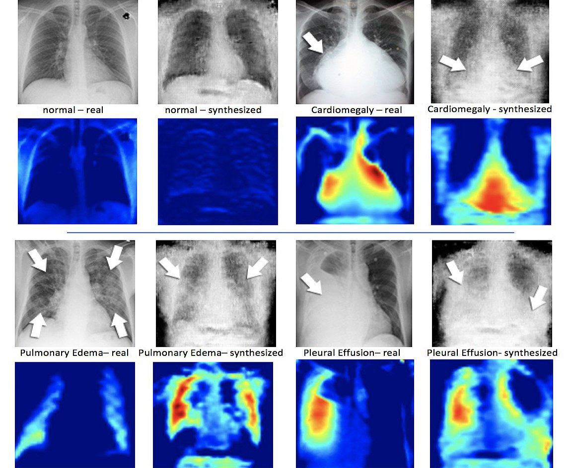 사진에서 각 사분면의 왼쪽에는 환자의 가슴과 그 옆에 있는 실제 X 선 이미지, DCGAN에 의해  합성된 X 선이 있다.(사진: MIMLab)