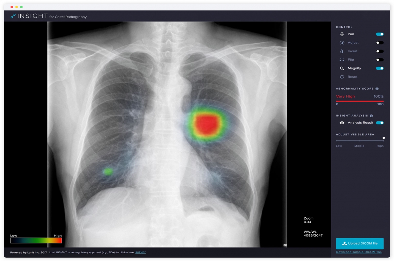 루닛의 딥러닝 기반의 AI와 흉부 X-ray 이미지인식 기술을 접목한 ‘의료영상진단 SW’ 시연화면(사진:본지DB)