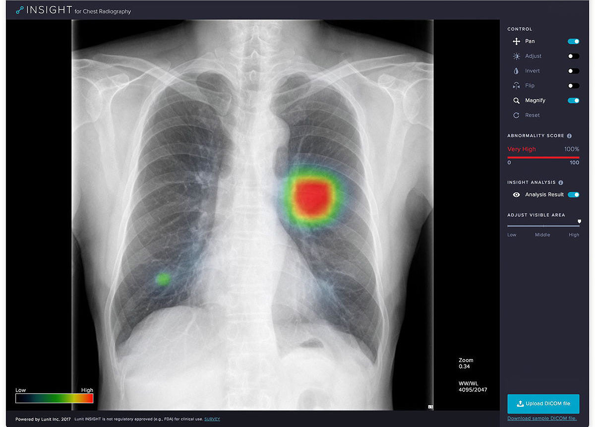 루닛 인사이트(Lunit INSIGHT for Chest Radiography Nodule Detection)는 흉부 엑스선 영상에서 폐암 결절로 의심되는 이상부위를 검출하여 의사의 판독을 보조하는 ‘의료영상 검출 소프트웨어’로서 2등급 의료기기에 속한다. 루닛은 독자적인 딥러닝 기술을 적용하여 최대 97%의 정확도를 달성했으며, 갈비뼈나 심장 등 다른 장기에 가려 놓치기 쉬운 결절도 정확히 찾아낼 수 있다.