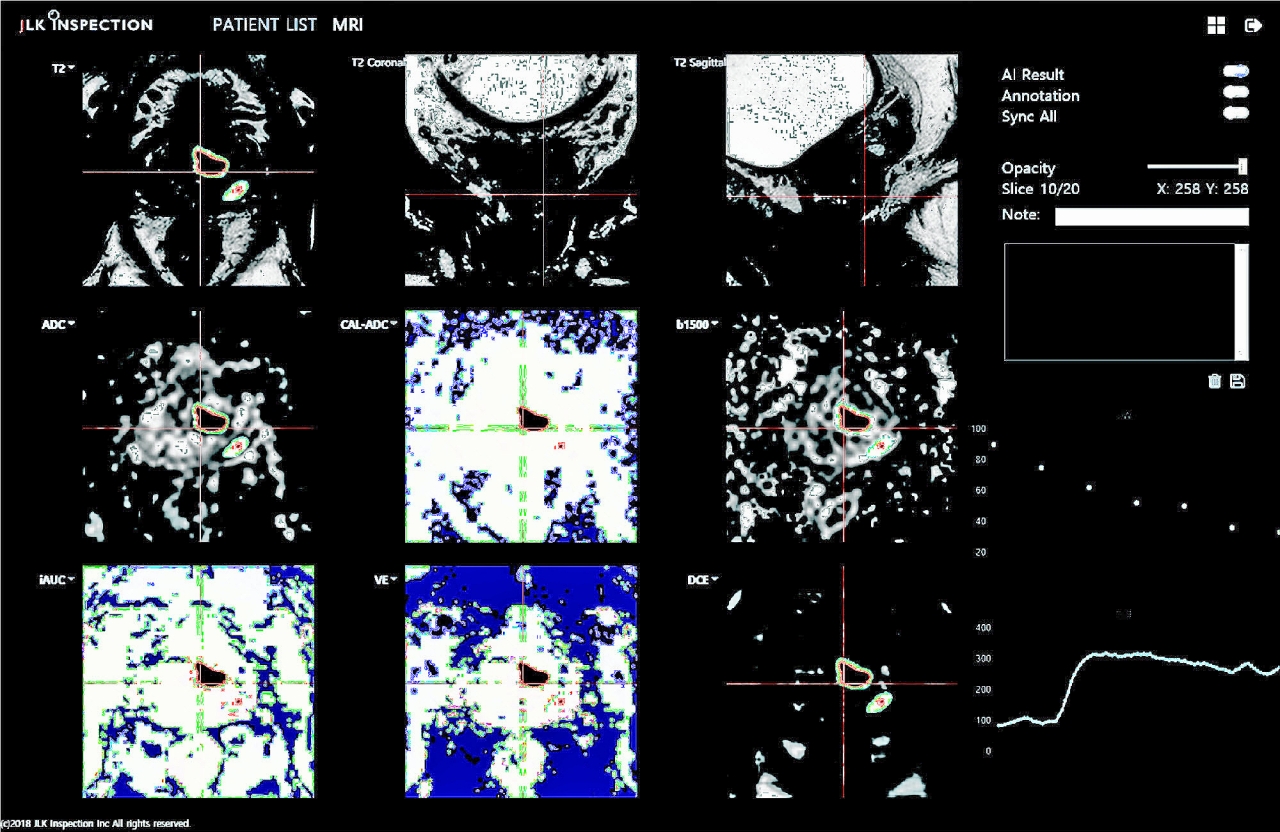 인공지능 기반 전립선 MR 의료영상 분석 솔루션 JPC-01K 시연 이미지