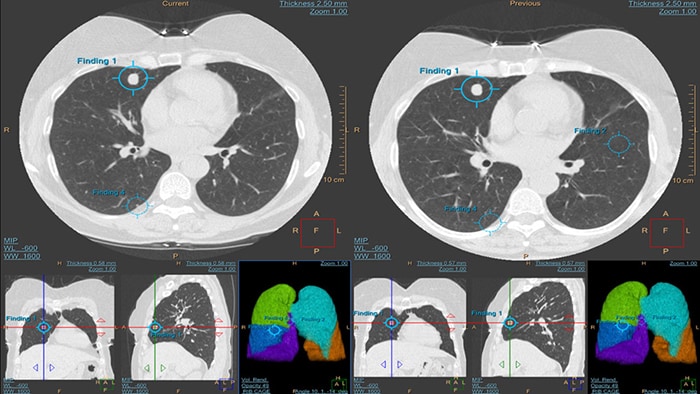 저용량 CT 스크리닝은 폐암의 조기 발견에 도움이 되고 머신러닝은 해당 스크리닝의 정확성을 높이는 데 도움이 될 수 있다.