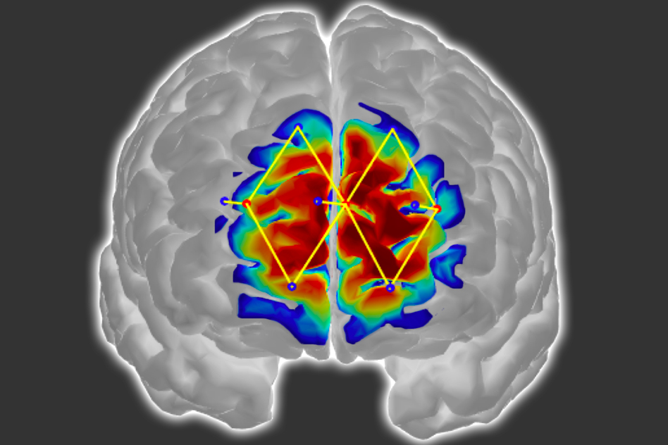 MIT-하버드 연구팀이 개발한 웨어러블 신경 이미징 장치에서 인공지능으로 뇌 신호를 통해 환자의 통증 수준을 감지한다. 이는 환자의 통증을 정량화하는 것으로 의사가 무의식 및 의사표현이 어려운 환자의 통증을 진단하고 치료하는 데 도움을 줄 수 있다.(사진:본지2019.09.13 기사 중에서)