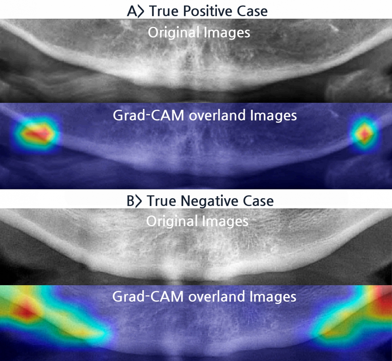 Grad-CAM 알고리즘을 이용하면 훈련된 딥러닝 모델이 골다공증 환자와 비-골다공증 환자의 치과용 파노라마 엑스레이를 분류하는 이미지상의 특이점의 위치를 알 수 있다.(사진:논문캡처)