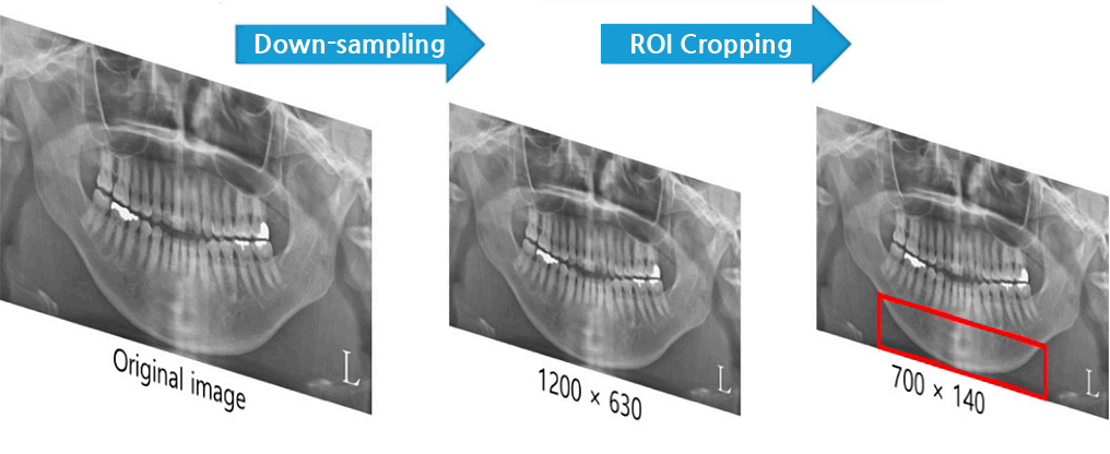본 연구의 영상 사전 처리 원래 DPR은 하향 샘플링 되었고, ROI는 치아 아래의 하악 영역(안쪽의 부위)으로 제한된다. DPR, 치과 파노라마 방사선 사진, ROI, 관심 영역(사진:논문 캡처)