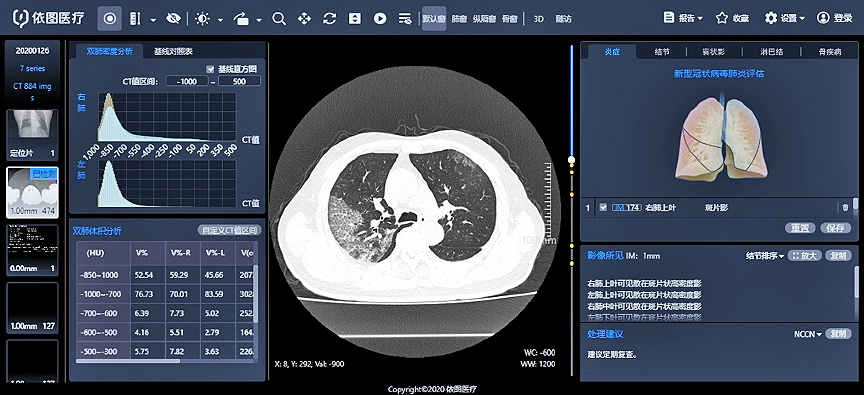 코로나19 용 폐 CT 시뮬레이션 평가 시스템의 사용자 인터페이스(사진:이투 헬스케어)