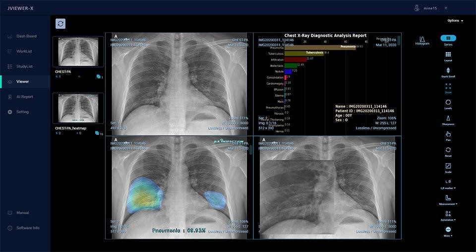 제이엘케이인스펙션 인공지능 흉부 X-Ray 솔루션 시연 이미지
