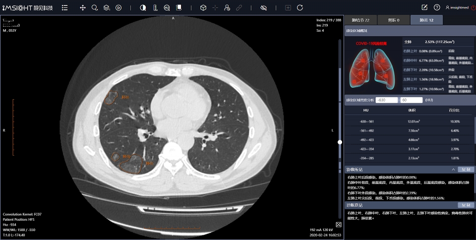 임사이트 AI플랫폼으로 코로나19로 진단된 30 세의 여성 환자의 이미지(사진:임사이트)