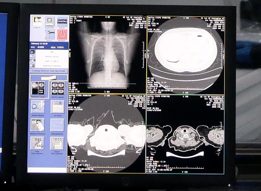 CT 이미지에서 폐렴의 병변을 자동으로 식별하는 Dharma Hospital Medical AI의 시연화면(사진:알리바바달마연구소)