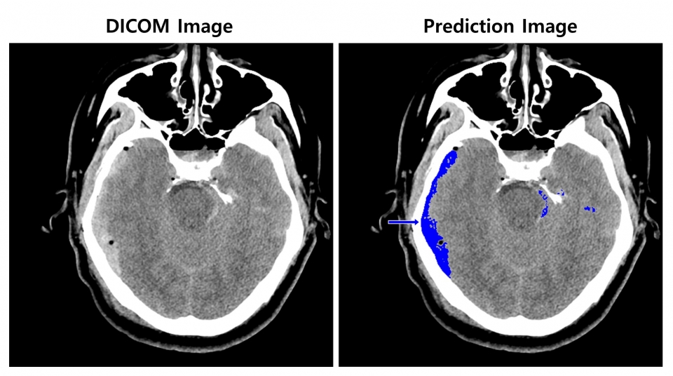 (좌) 뇌출혈이 의심되는 환자의 뇌 CT 영상  (우) 뇌출혈 영상 판독 AI모델이 출혈 병변(화살표) 존재와 위치를 식별한 영상
