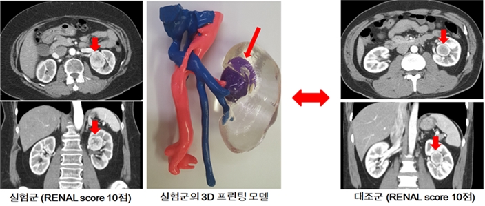 실험군(수술에 3D 프린팅 모델 활용)과 대조군의 수술 전 컴퓨터 단층촬영(CT) 사진 비교
