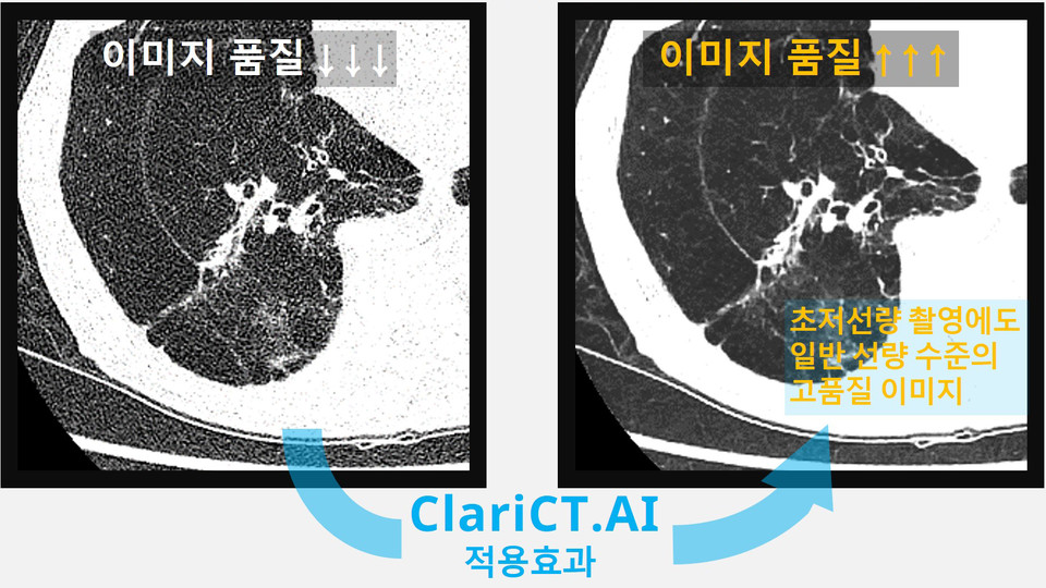 초저선량 CT의 클라리파이 AI 효과 비교(사진;클라리파이)