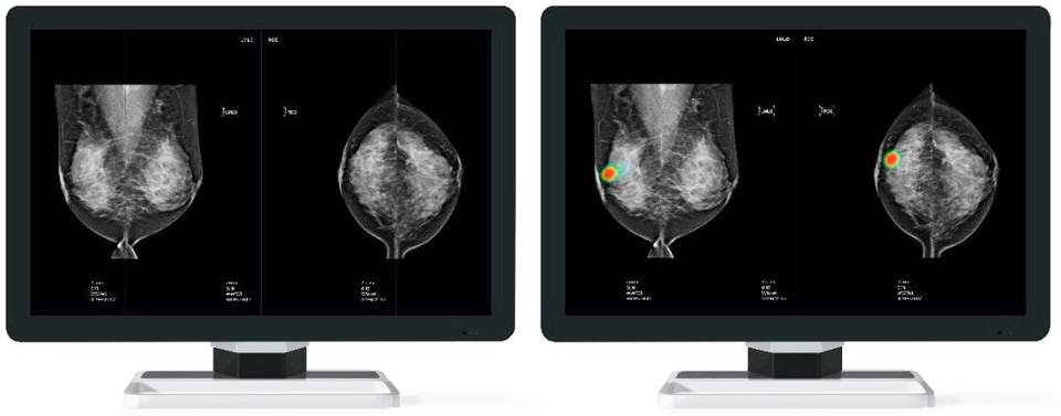 루닛의 유방암 진단 보조 AI 솔루션 ‘루닛 인사이트 MMG’ 시연 화면