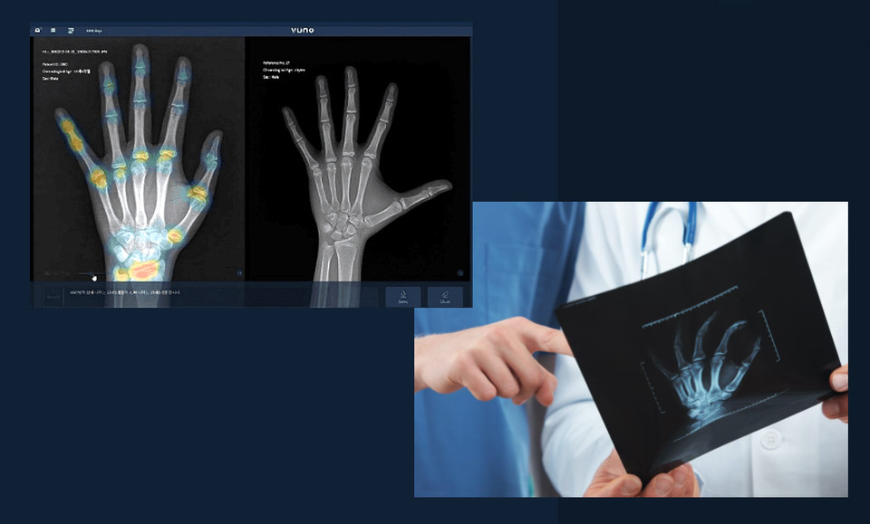 사진은 뷰노 Med-BoneAge 시연 이미지로 수골 X-ray 영상을 AI가 자동 분석하여 가장 유사한 골연령을 최대 3순위까지 제시해 의료진이 환자의 골연령을 판단하는 것을 지원한다.(사진:뷰노)