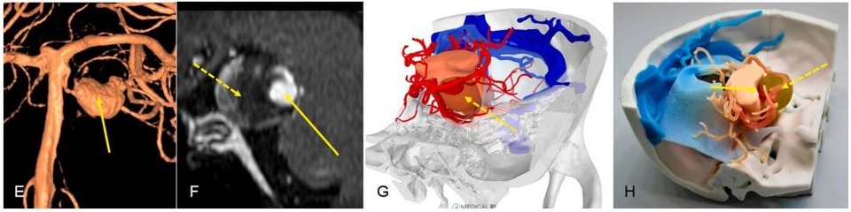 뇌혈관질환 환자 의료영상 기반 3D모델링 및 3D프린팅 case1 동맥류