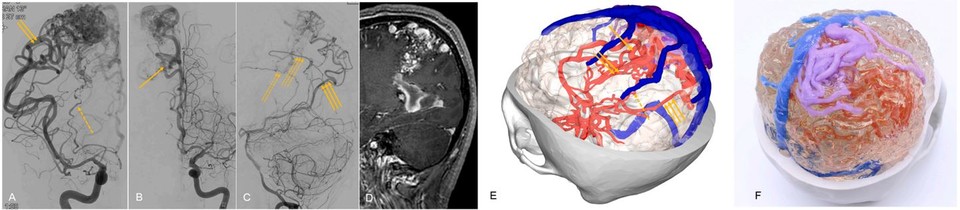 뇌혈관질환 환자 의료영상 기반 3D모델링 및 3D프린팅 case2 동정맥기형
