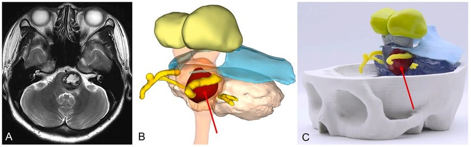 뇌혈관질환 환자 의료영상 기반 3D모델링 및 3D프린팅 case3 해면기형