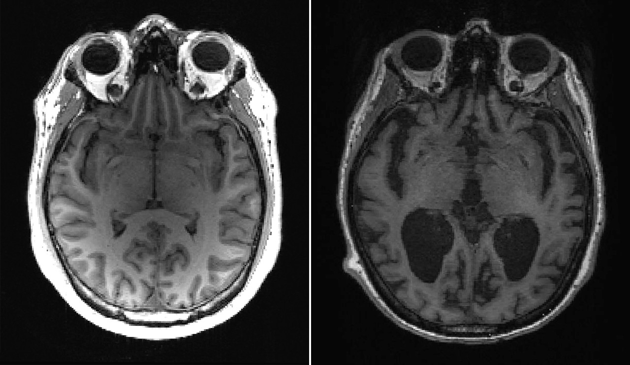 (왼쪽부터)건강한 MRI 뇌 스캔 이미지와 알츠하이머 환자의 MRI 뇌 스캔 이미지(사진:Timothy Rittman)