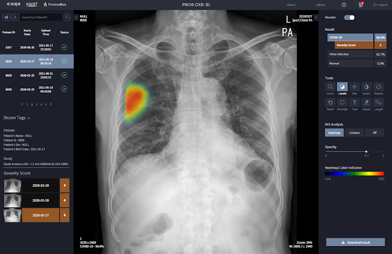 사진은 PROS CXR: ID 솔루션 시연 화면으로 솔루션은 흉부 방사선 사진(CXR)에서 코로나19 관련 폐렴, 기타 감염성 질환(세균성 폐렴, 결핵) 등에서 3가지 등급으로 분류한다.