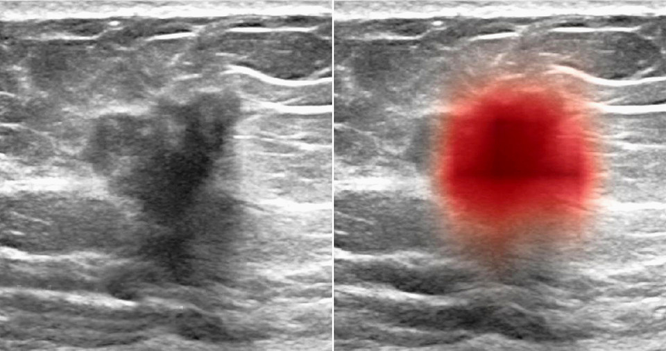 연구팀의 AI로 유방 초음파 이미지에서 암을 식별한다(왼쪽, 중앙의 어두운 부분, 오른쪽은 컴퓨터에서 강조 표시된 빨간색).사진:뉴욕대
