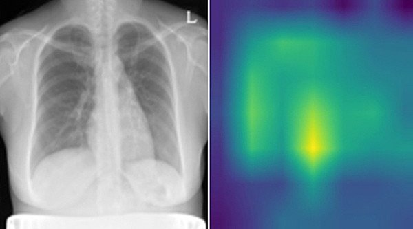 왼쪽부터, X-RAY 흉부영상(비정상), Grad-CAM을 활용한 비정상 부위 시각화 이미지
