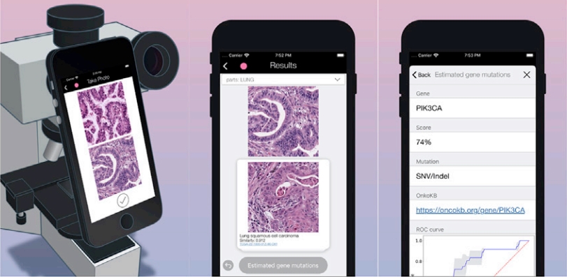 CBIR 스마트폰 프로그램 사용, 사용자가 스마트폰 카메라로 촬영한 원본 암 조직학 영상을 업로드하면 조직학적으로 유사한 영상과 예측 돌연변이가 표시된다.