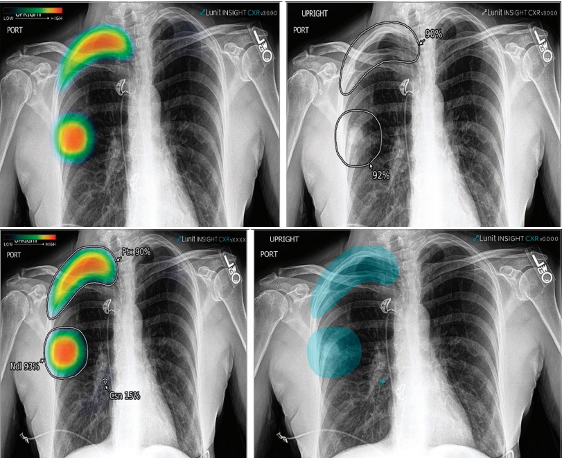 Análise de imagens de raios-X do tórax Solução de IA 'Lunit Insight CXR' imagens em vários modos de exibição (Foto: DB)