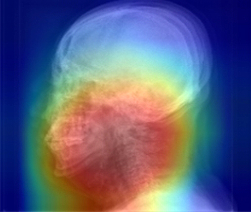 두경부 X-ray 영상을 활용한 수면무호흡증 진단 예시:딥러닝 알고리즘이 수면무호흡증 여부를 분류하는 이미지 상 특이점의 위치(붉은색)를 확인할 수 있다.