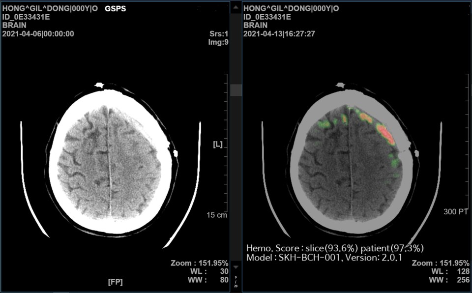사진은 AI 뇌출혈 영상 의료 솔루션(메디컬 인사이트 플러스 뇌출혈) 시연 화면