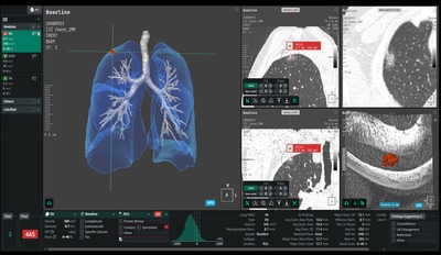 흉부 CT 한 번으로 폐·심혈관 위험 함께 본다…강남하트스캔, 코어라인소프트 'AVIEW Aorta' 도입