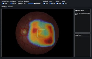 AI로 증상 없는 만성질환 합병증 찾는다… 아크-자이메드, 망막 AI 협력