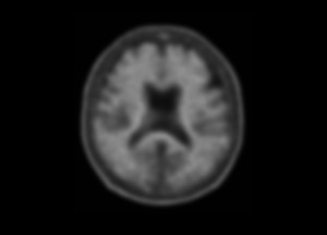 한림대성심병원, 알츠하이머 진단·치료 전략 정밀도 높여...AI기반 아밀로이드PET정량분석 임상 도입
