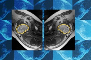 태아 뇌 MRI, AI가 움직임 따라 실시간 조정…대칭성 학습으로 산전 진단 정확도 높였다